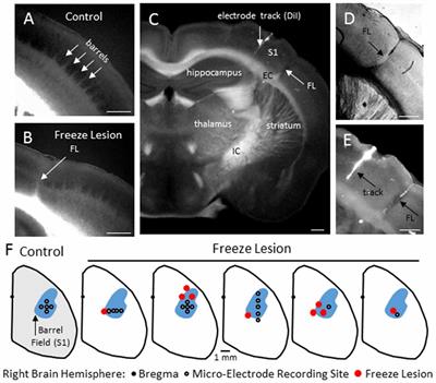 Enhanced Burst-Suppression and Disruption of Local Field Potential Synchrony in a Mouse Model of Focal Cortical Dysplasia Exhibiting Spike-Wave Seizures